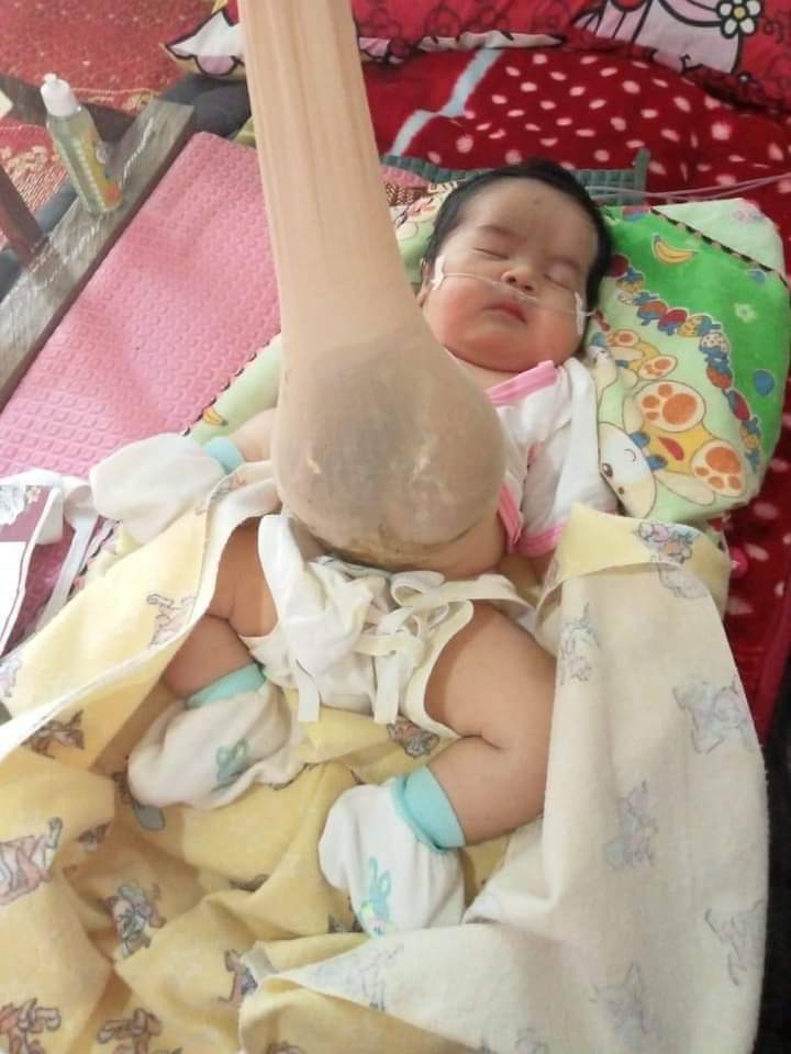 Tak Punya Biaya Lagi, Bayi Mungil Pengidap Omfalokel Terpaksa Keluar dari RSUD Arifin Achmad