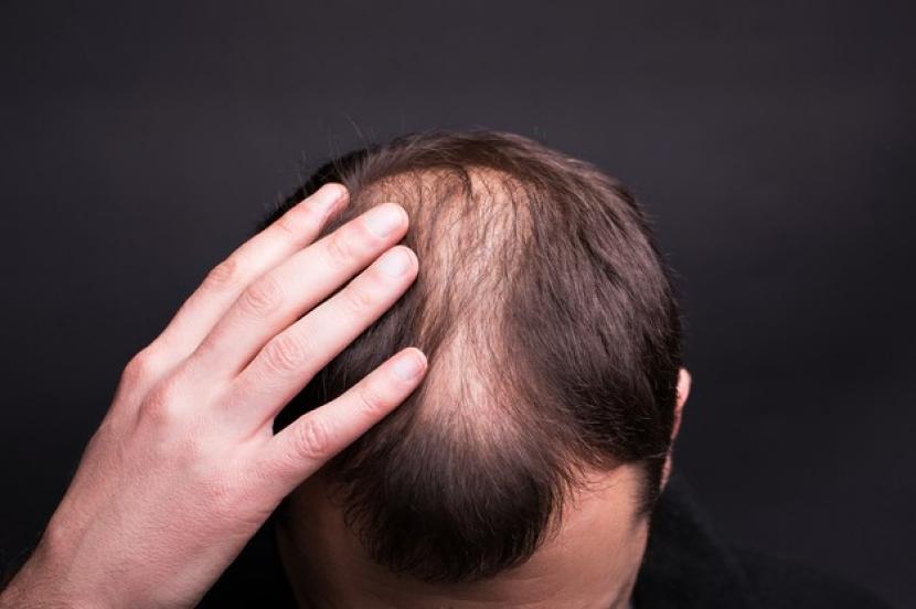 Transplantasi Rambut Jika Alami Kebotakan, Bolehkah?