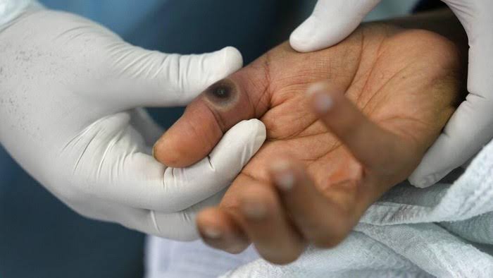 Kabupaten/Kota di Riau Diminta Segera Lakukan Pencegahan dan Antisipasi Cacar Monyet